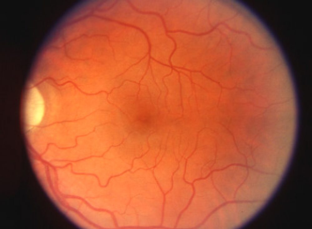 Retina, specchio della tua salute